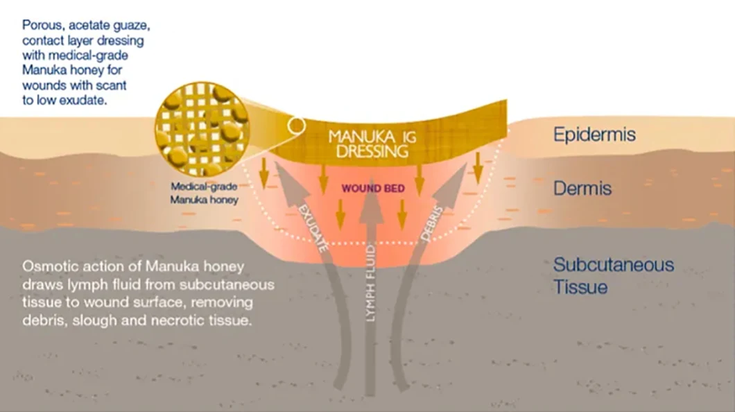 Manuka Honey Medical Wound Care Surgical Gauze Dressing